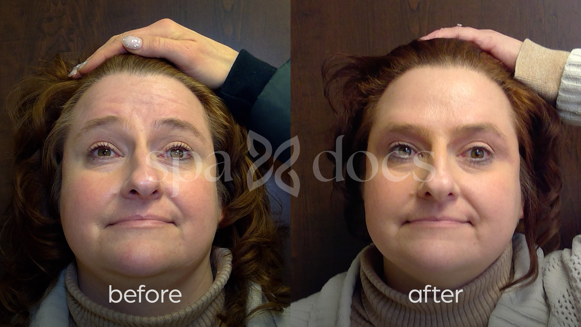 botox-before-after