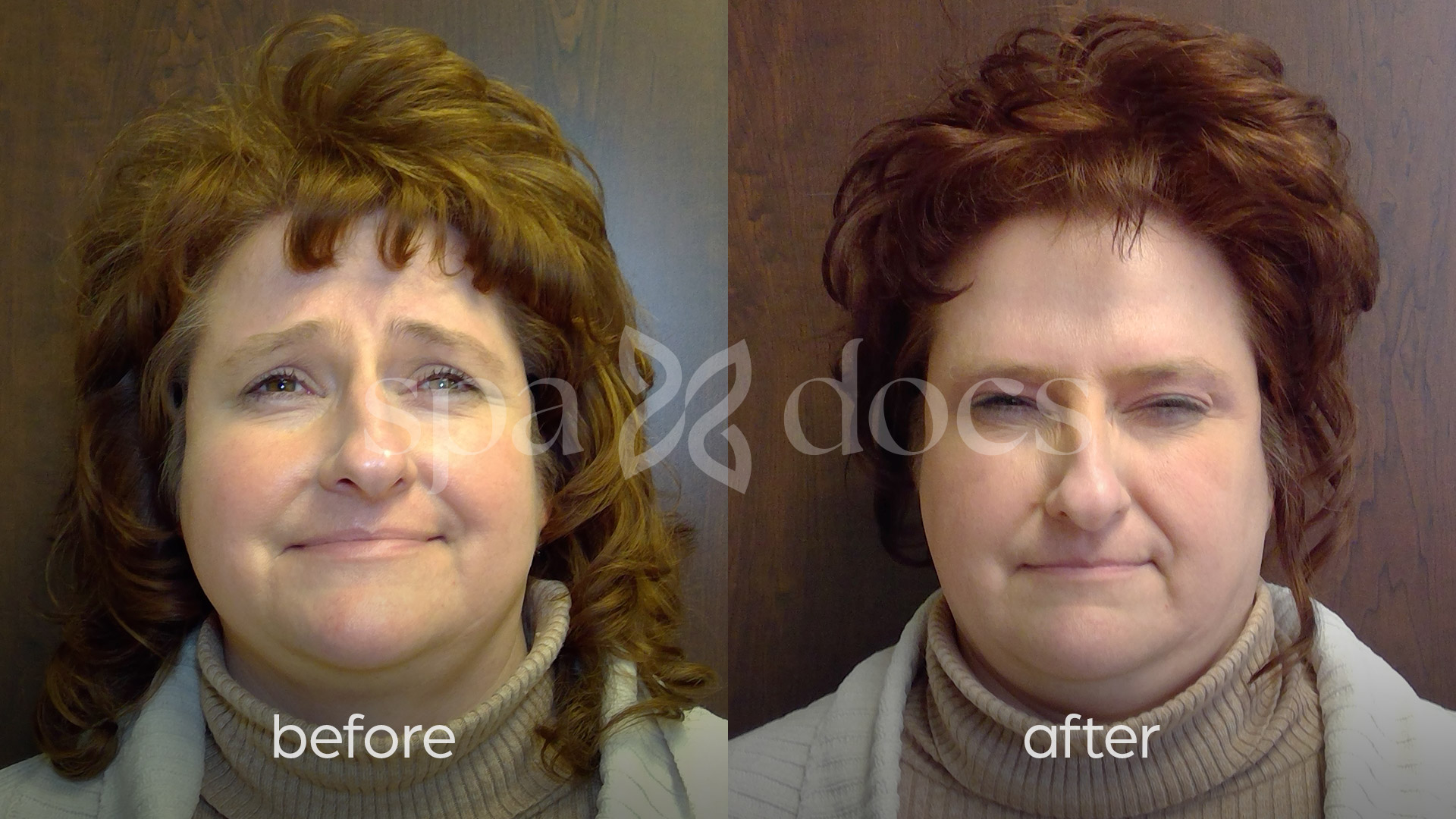 botox-before-after
