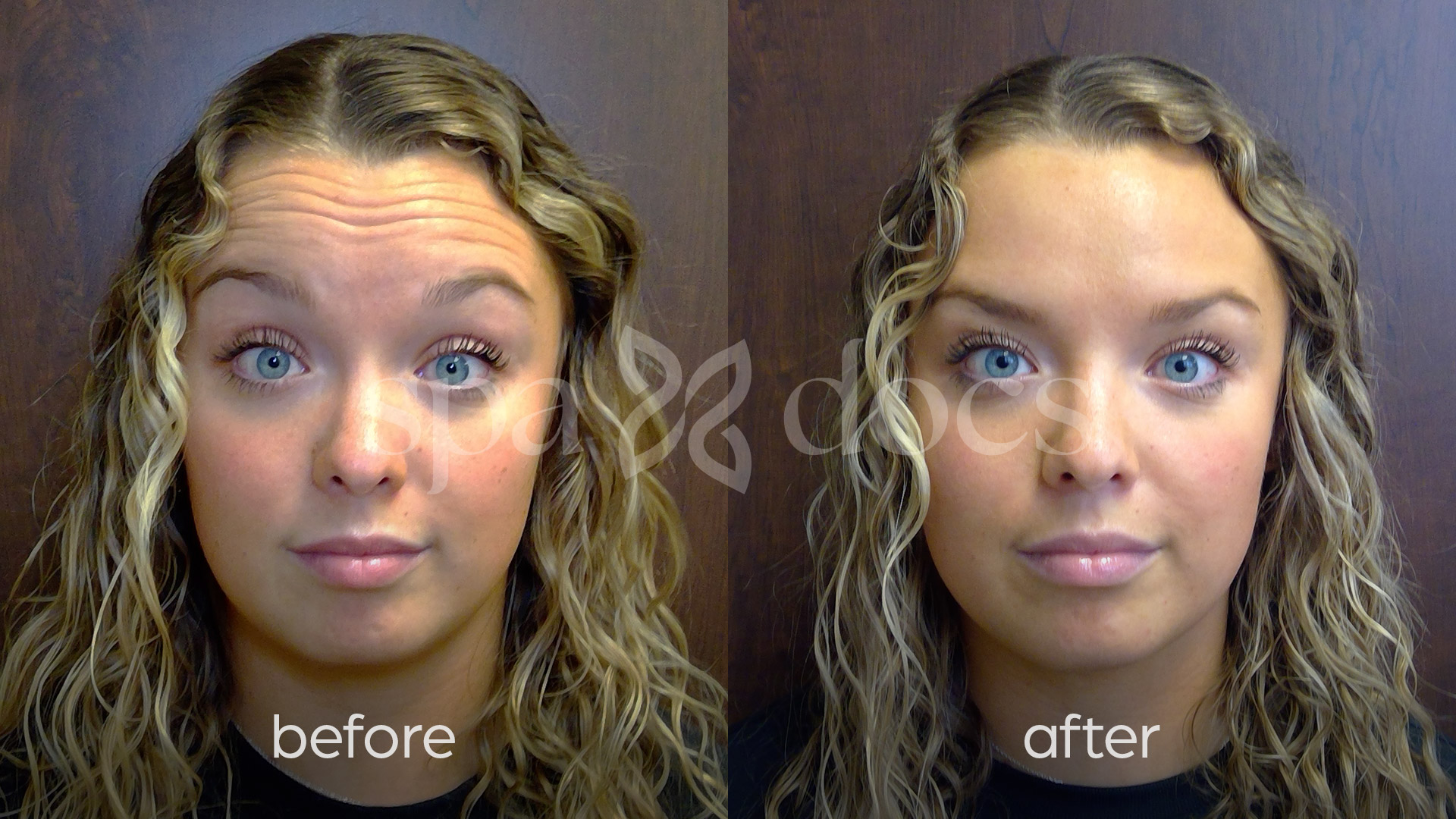 botox-before-after
