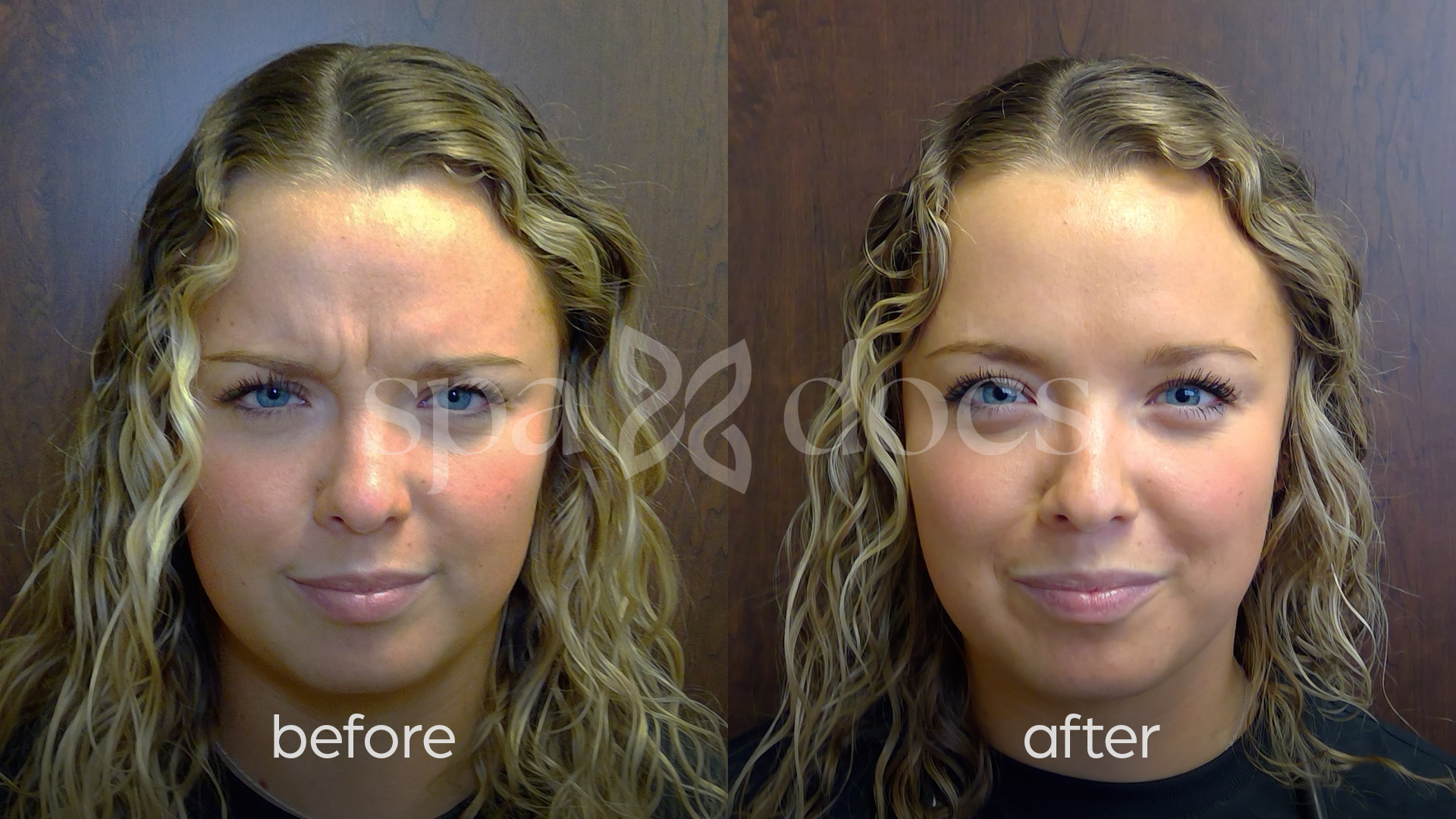 botox-before-after