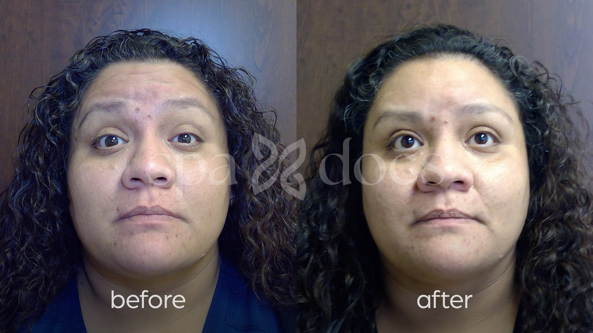 botox-before-after