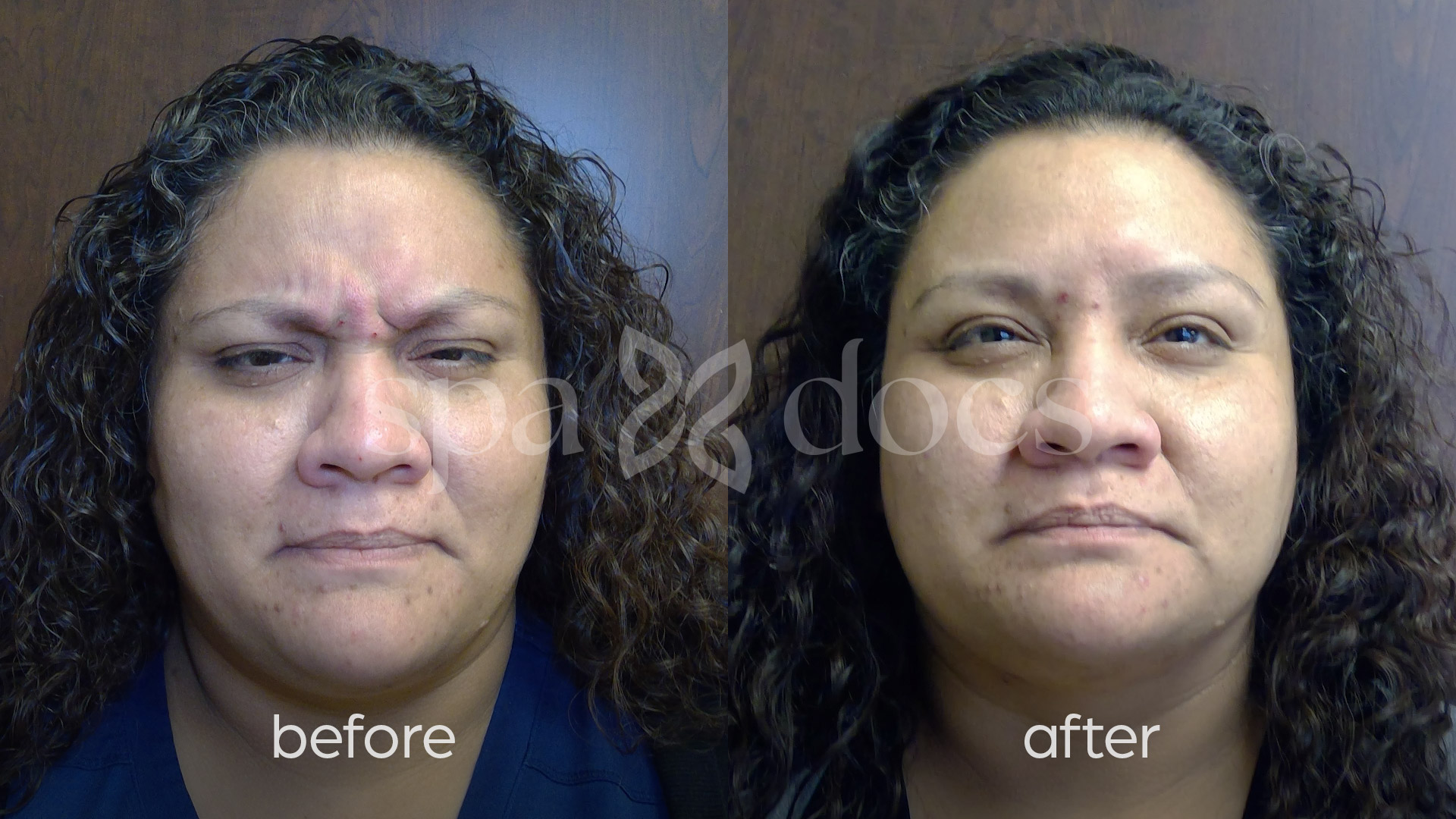 botox-before-after