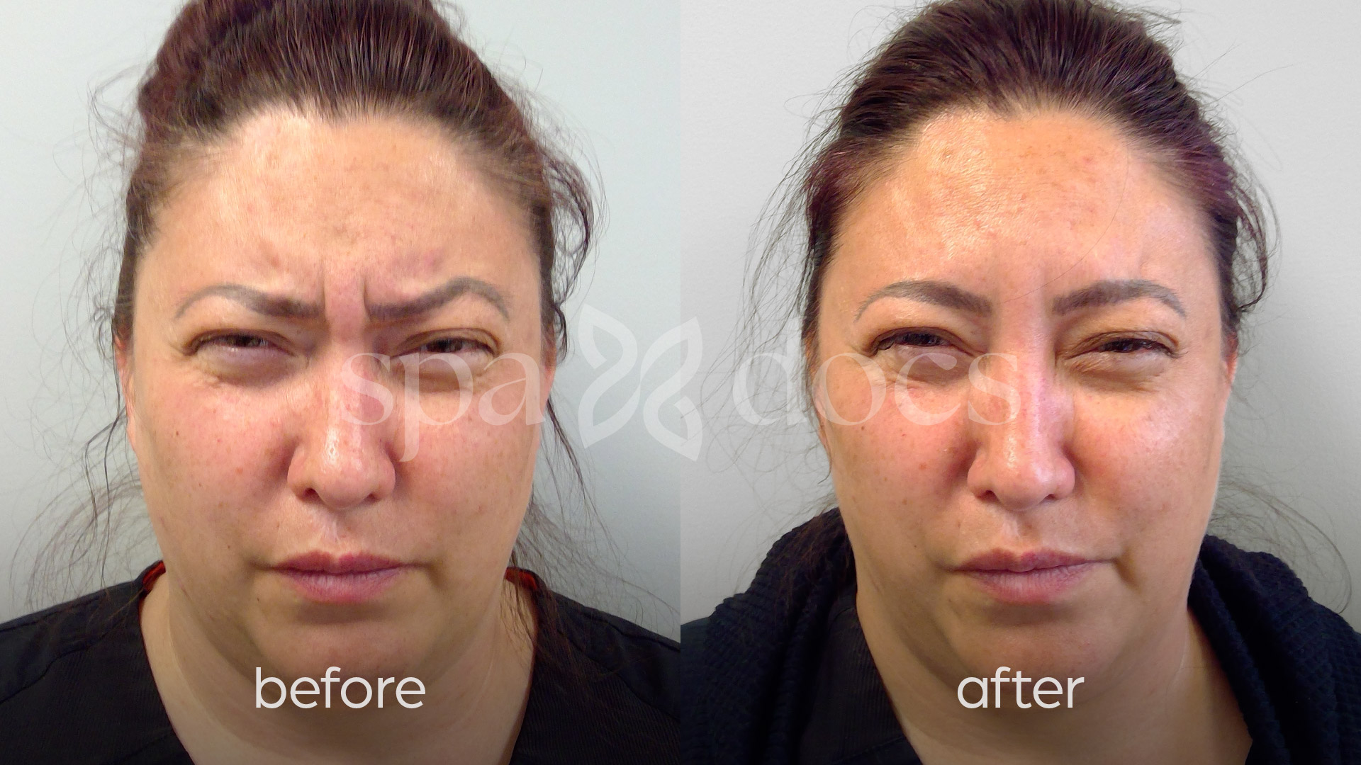 botox-before-after