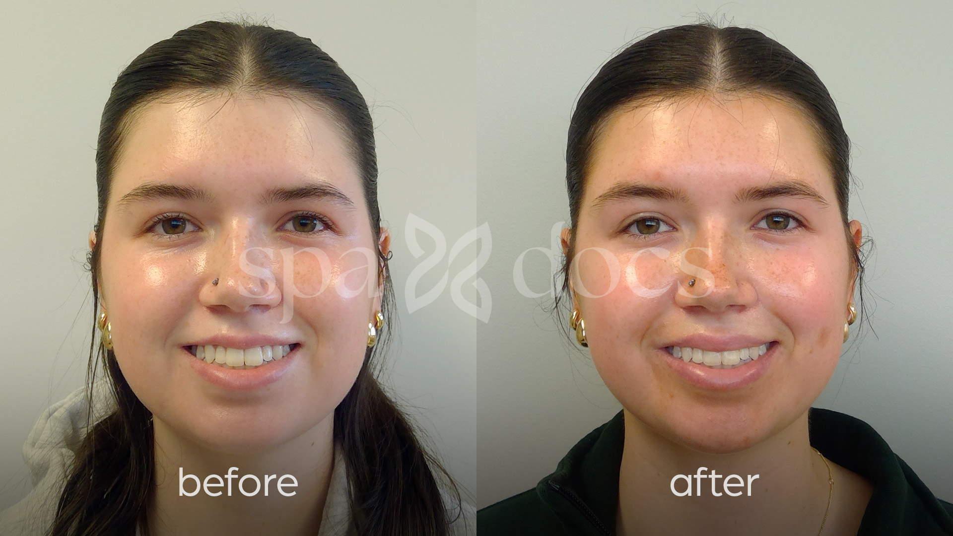 botox-before-after