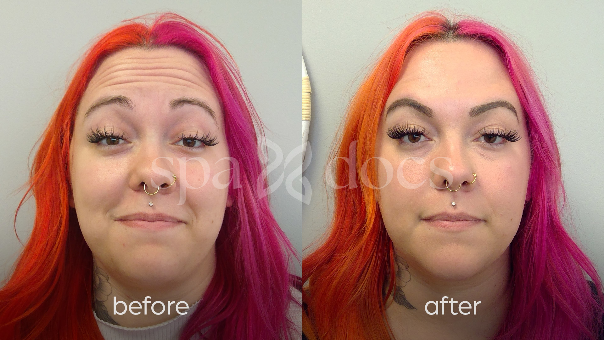 botox-before-after