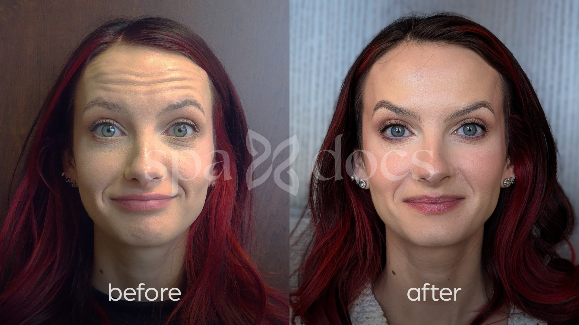 botox-before-after