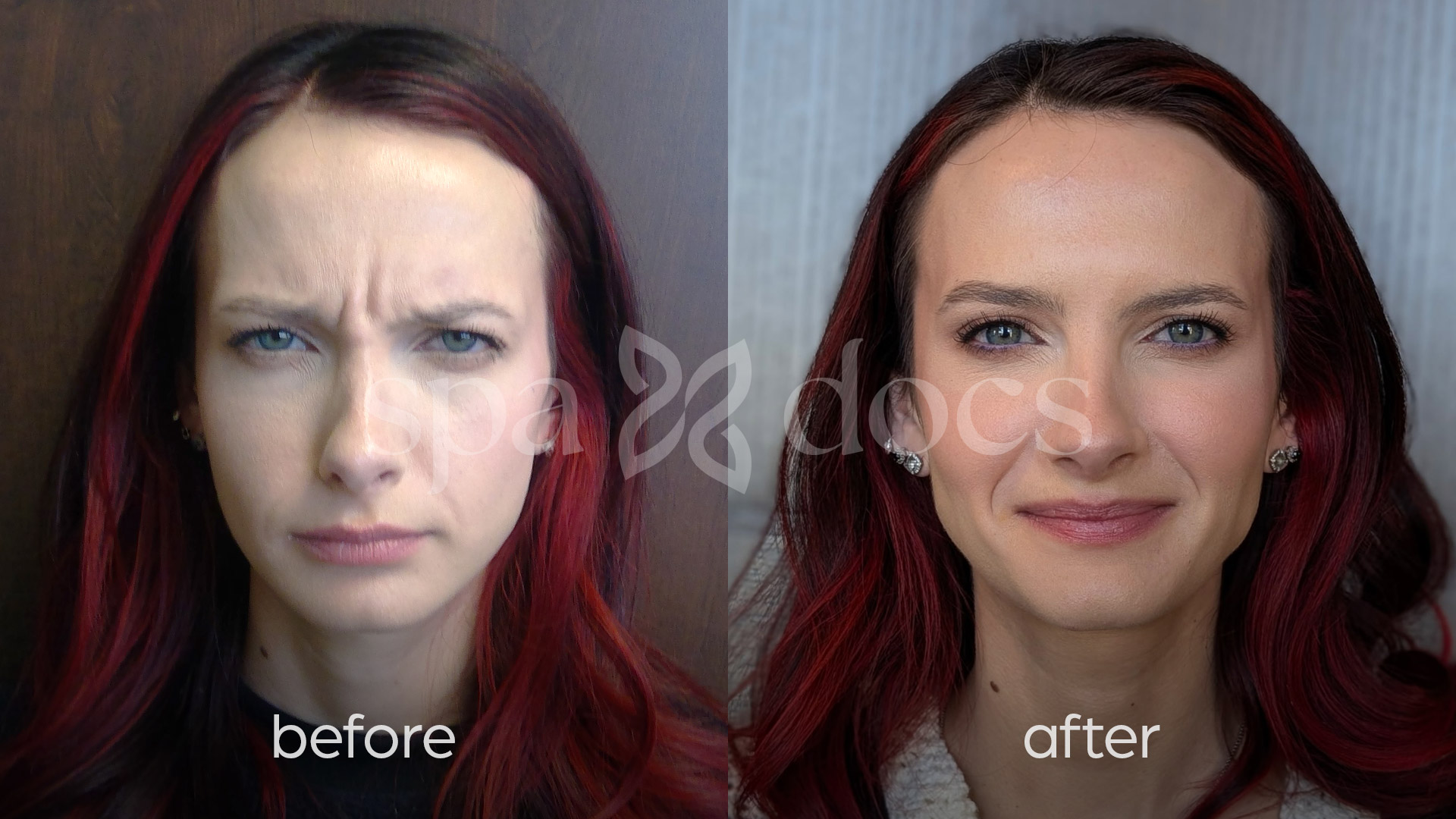 botox-before-after