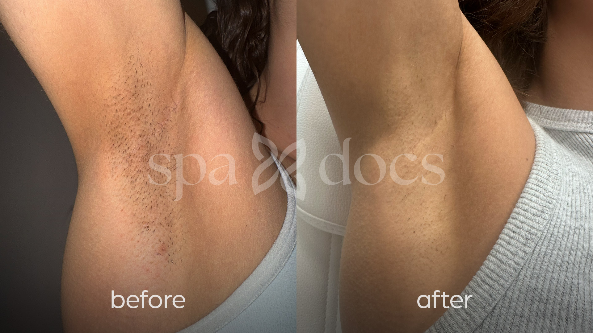 laser-hair-removal-before-after