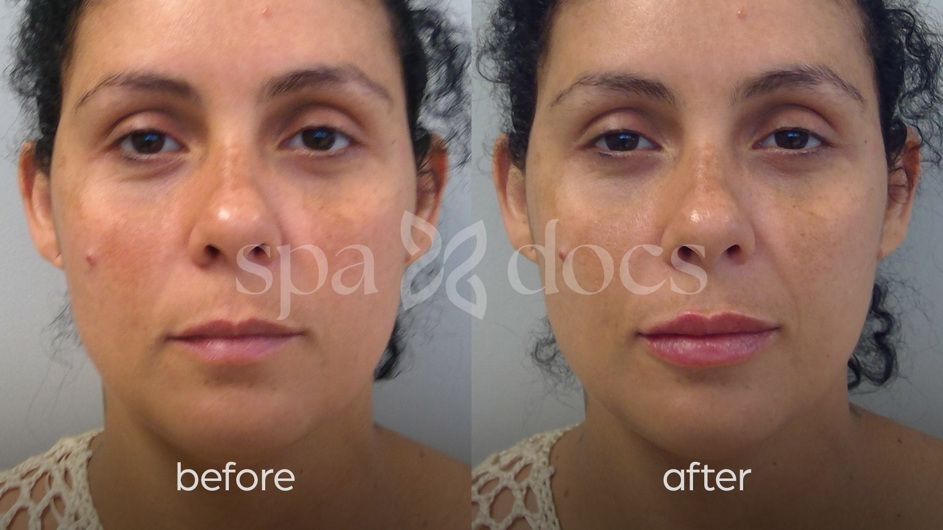filler-before-after