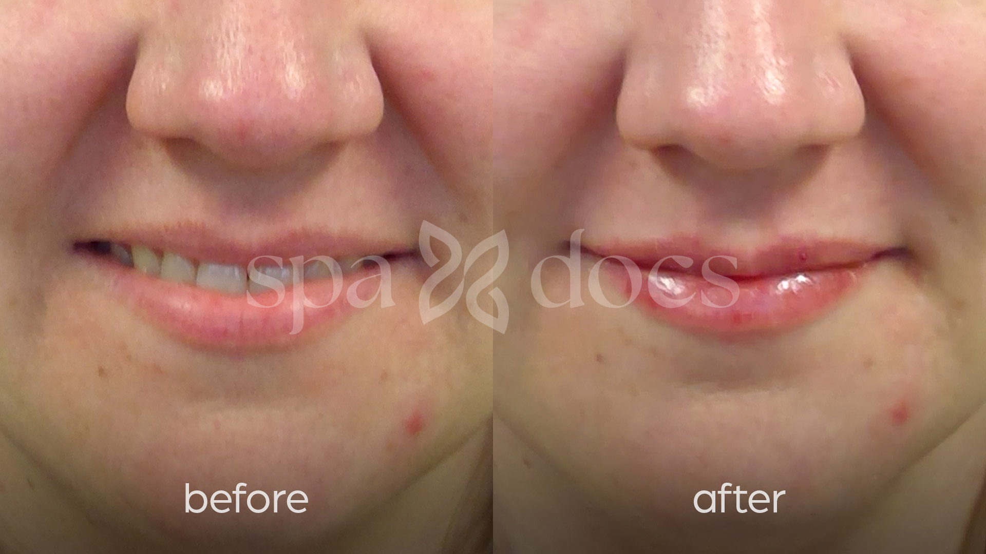 filler-before-after