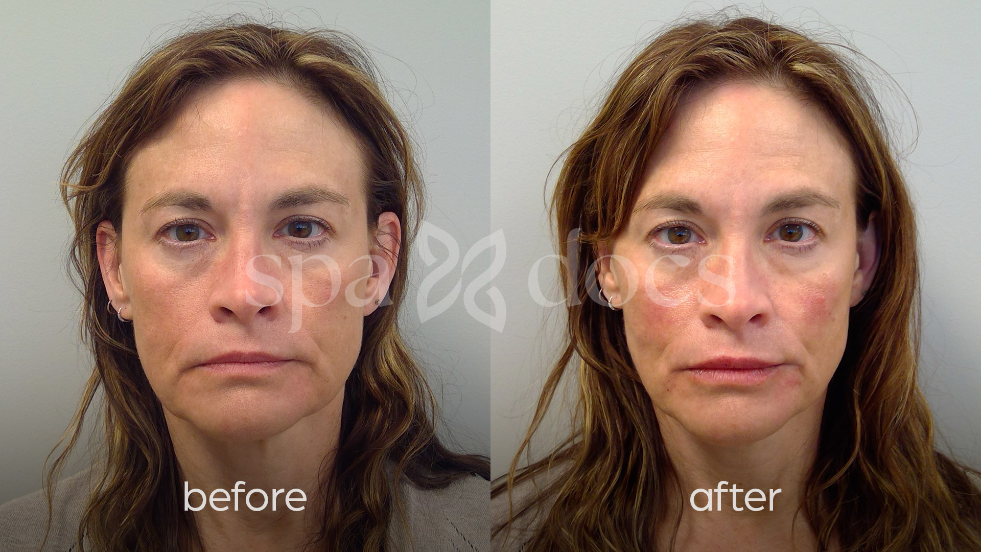 filler-before-after