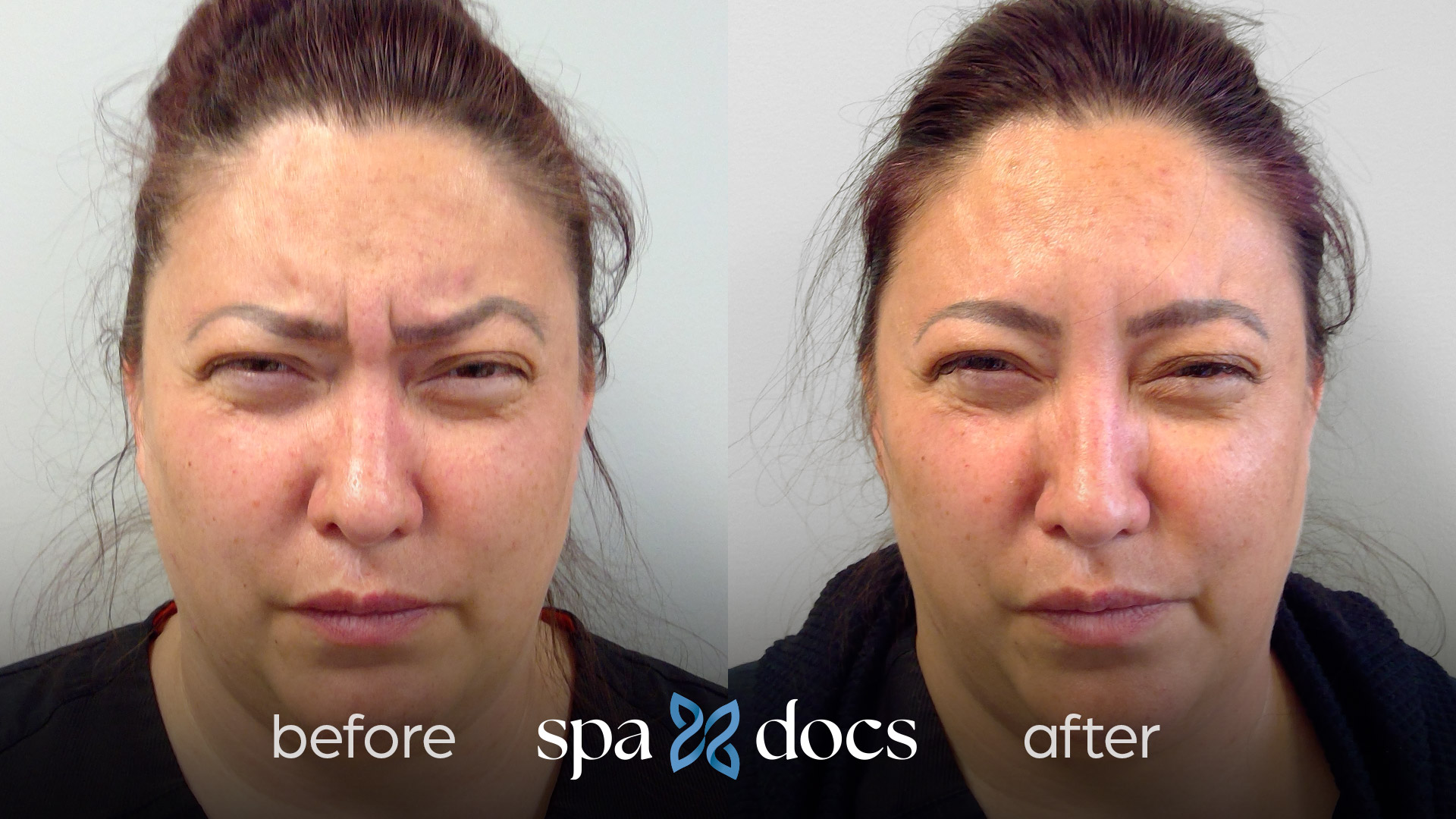 botox-before-after