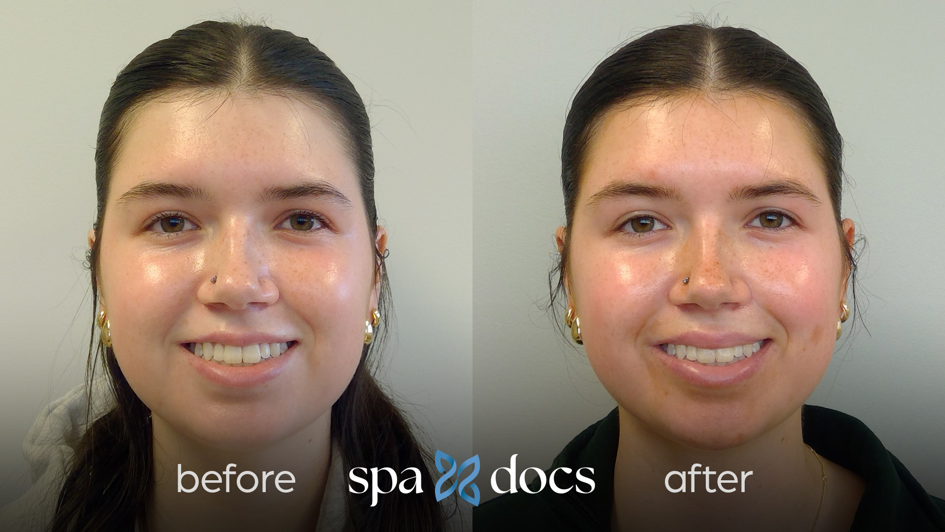 botox-before-after