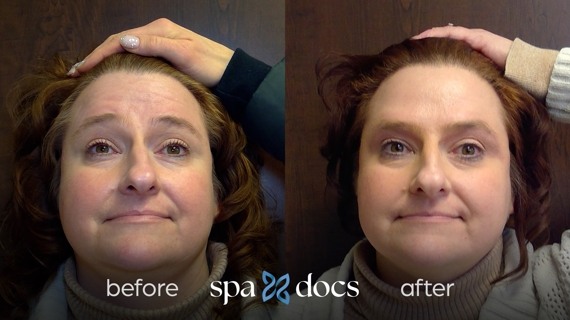 botox-before-after