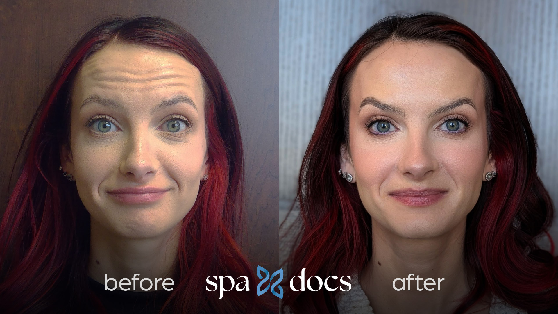 botox-before-after