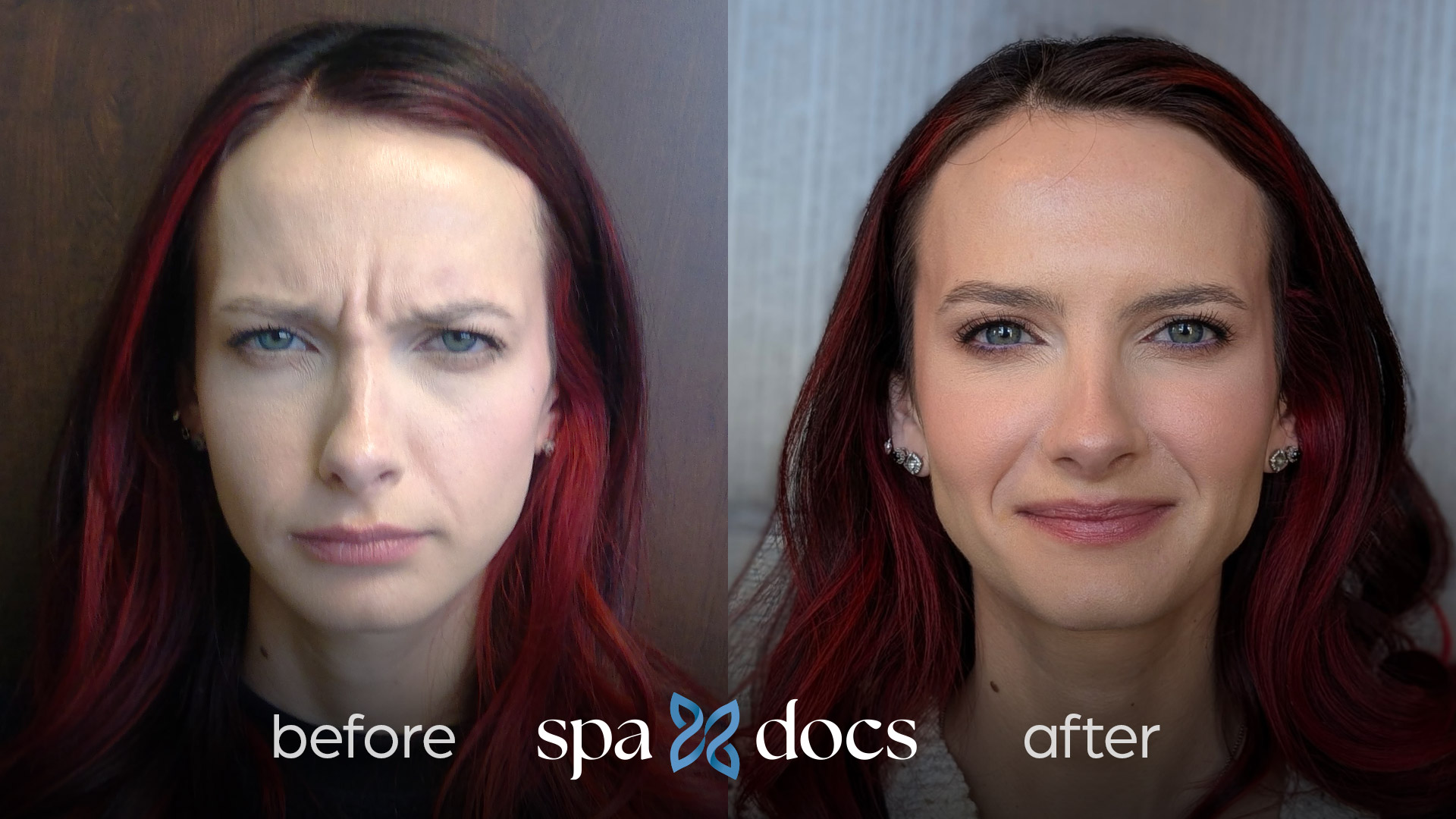 botox-before-after