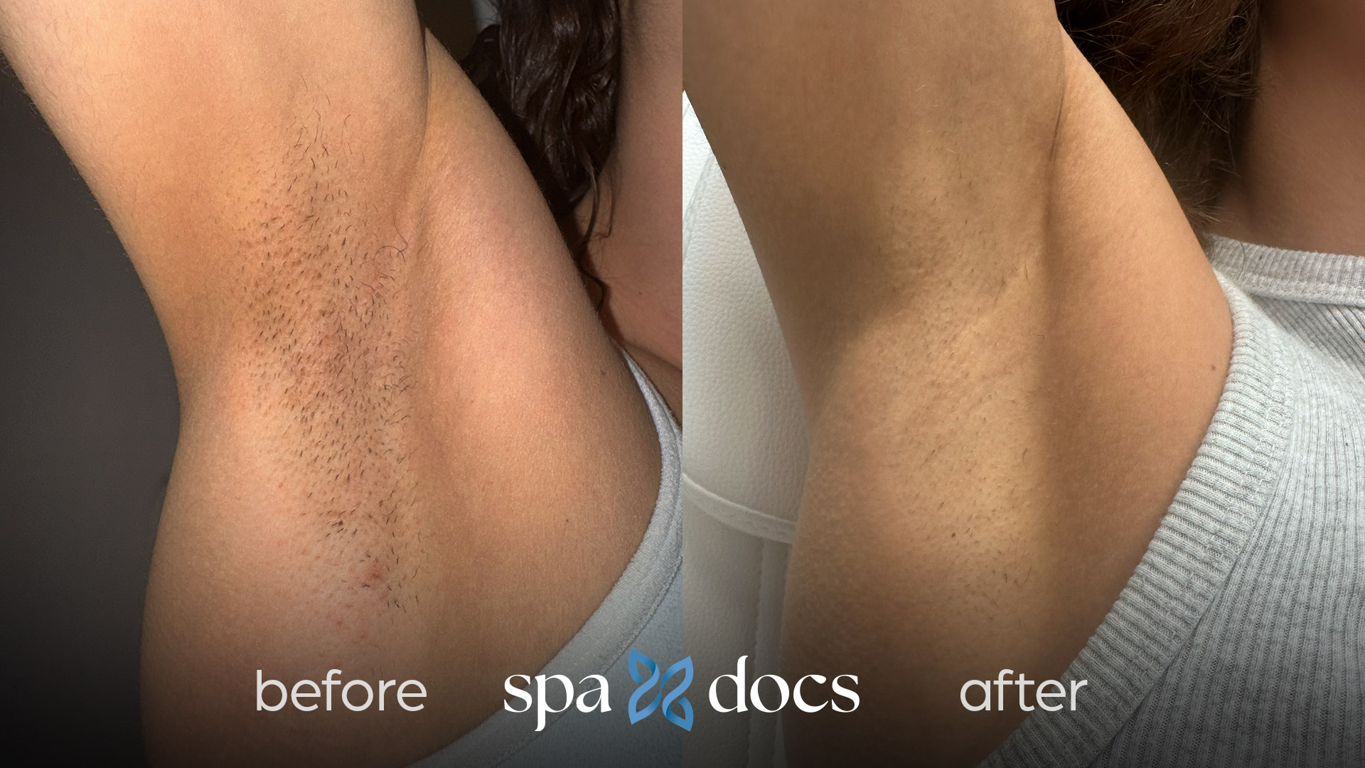 laser-hair-removal-before-after