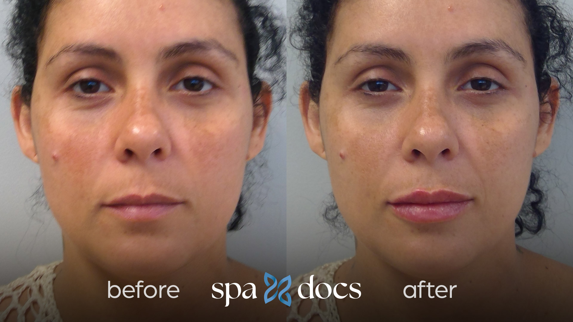 filler-before-after