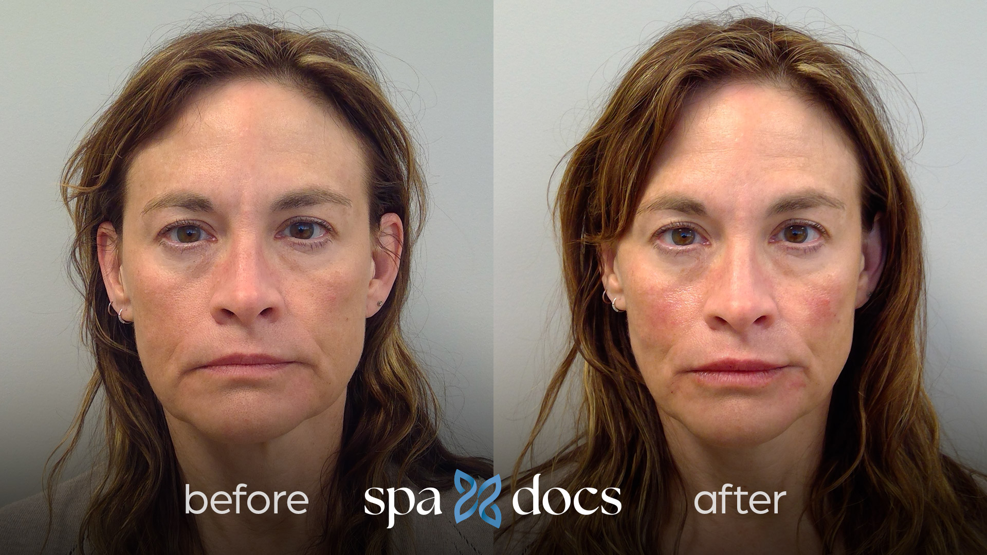 filler-before-after