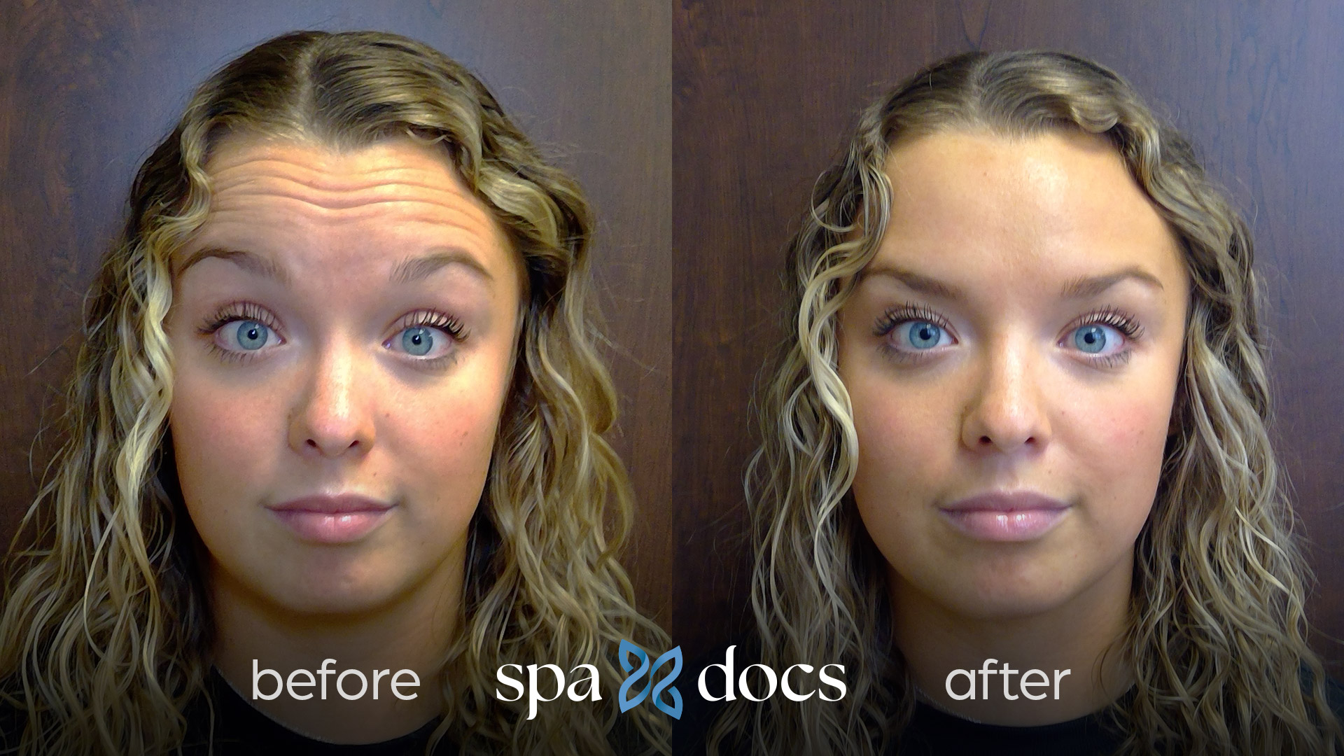 botox-before-after