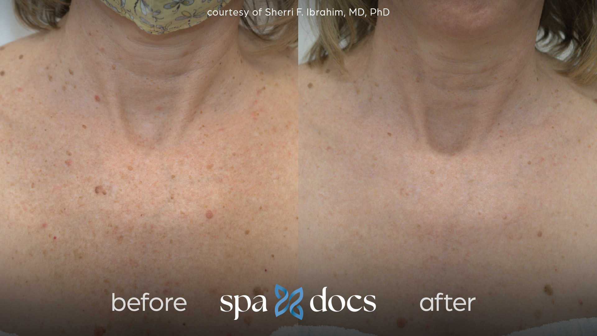 before and after bbl