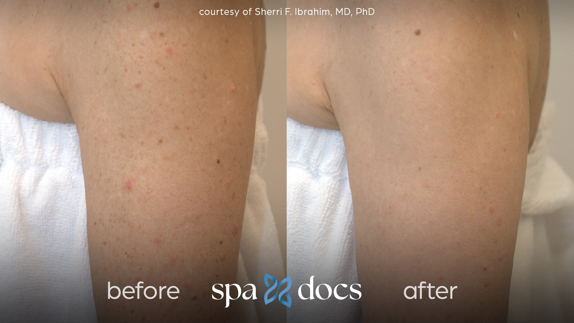 before and after bbl