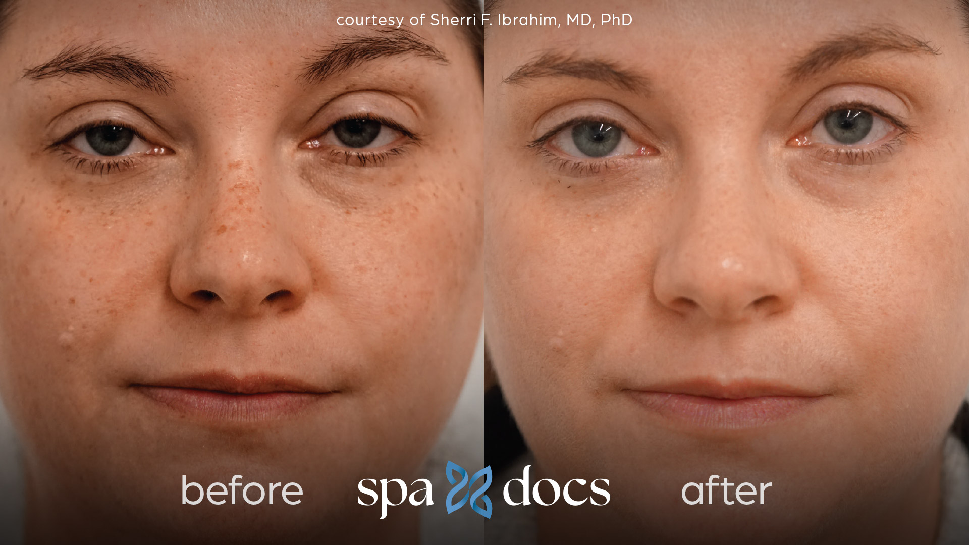 before and after bbl