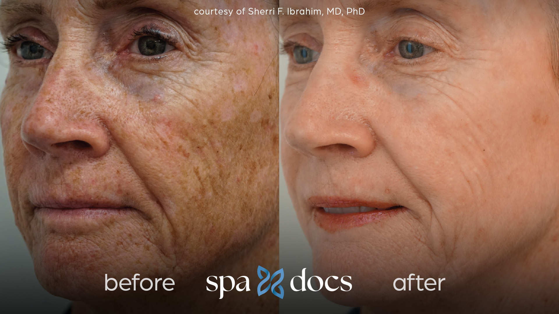 before and after bbl