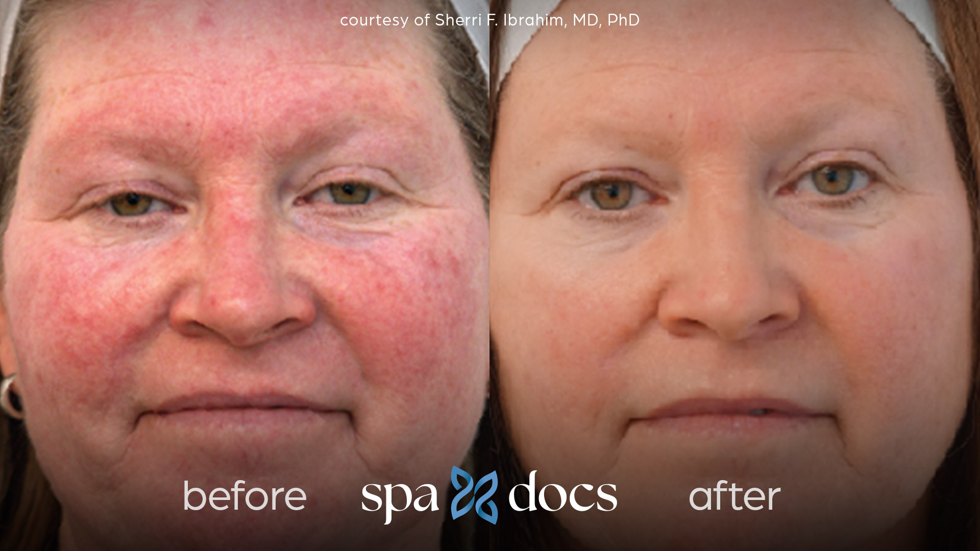 before and after bbl