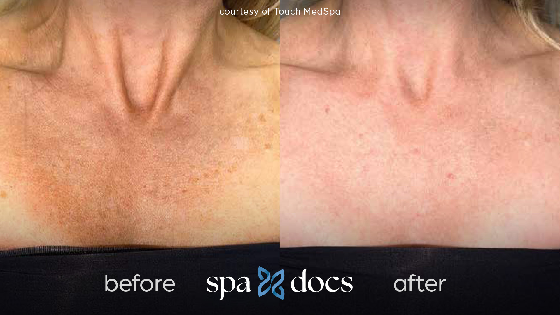 before and after bbl