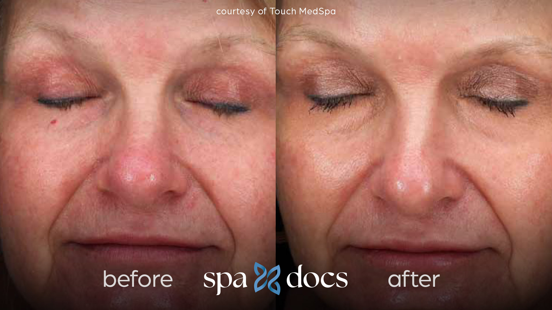 before and after bbl