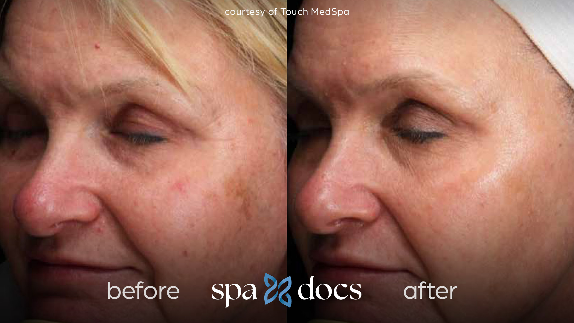 before and after bbl