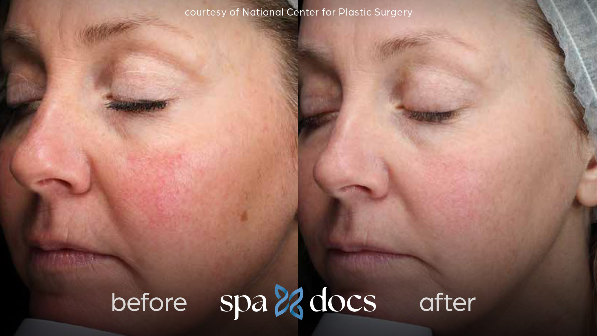 before and after halo