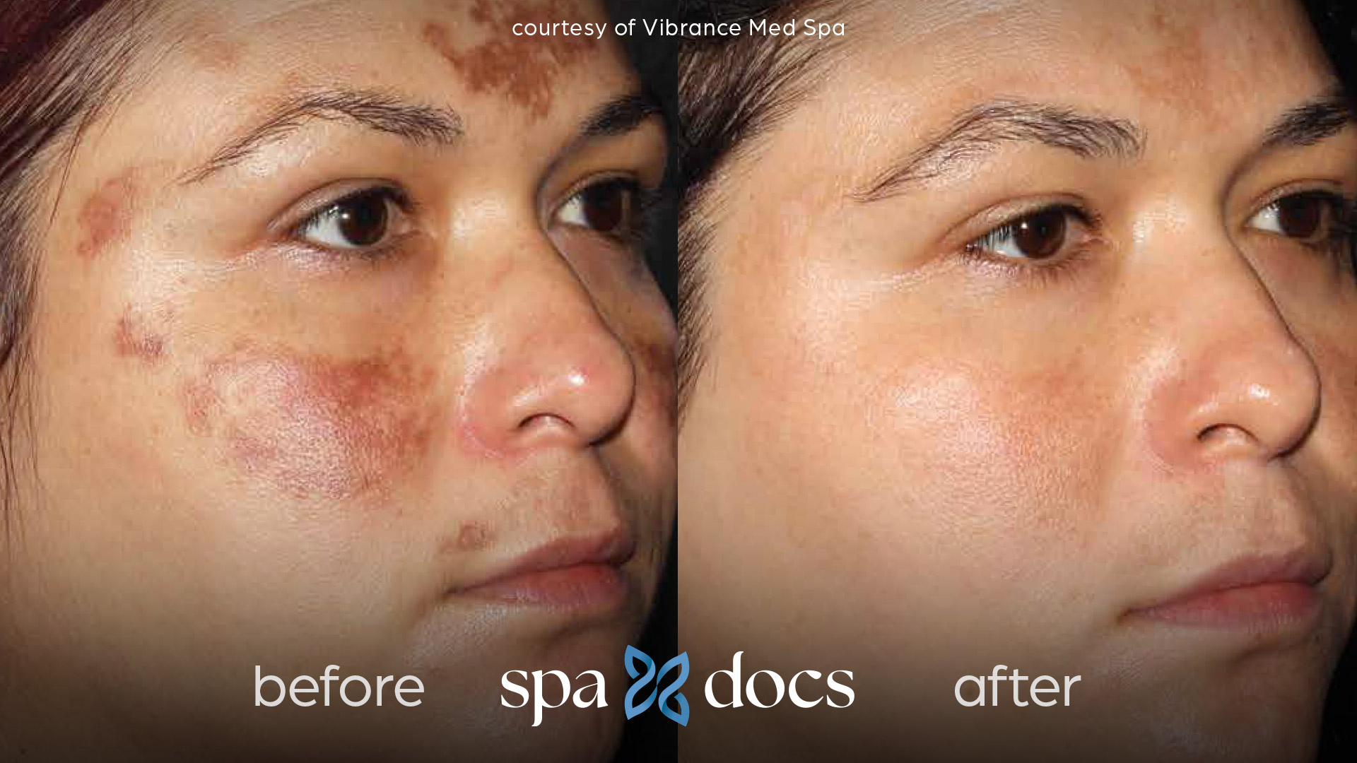 before and after halo