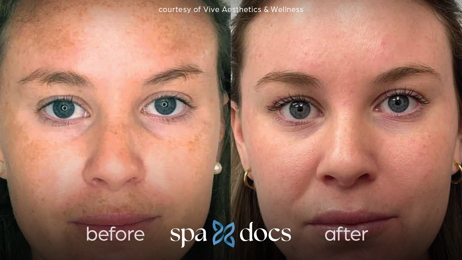 before and after halo