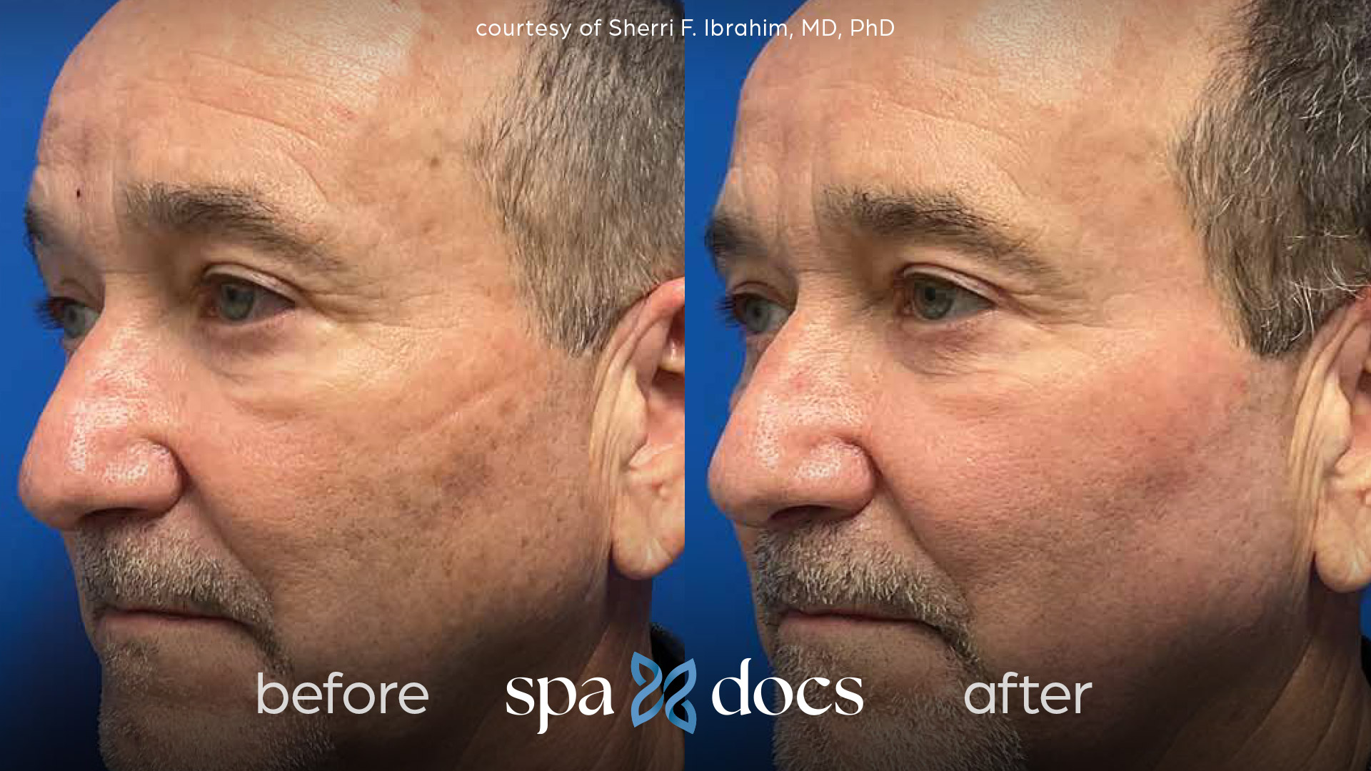 before and after halo