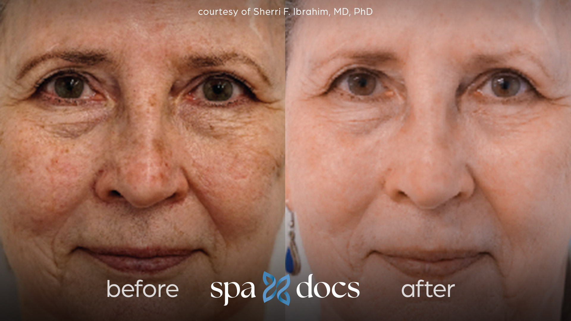 before and after hyperpigmentation removal