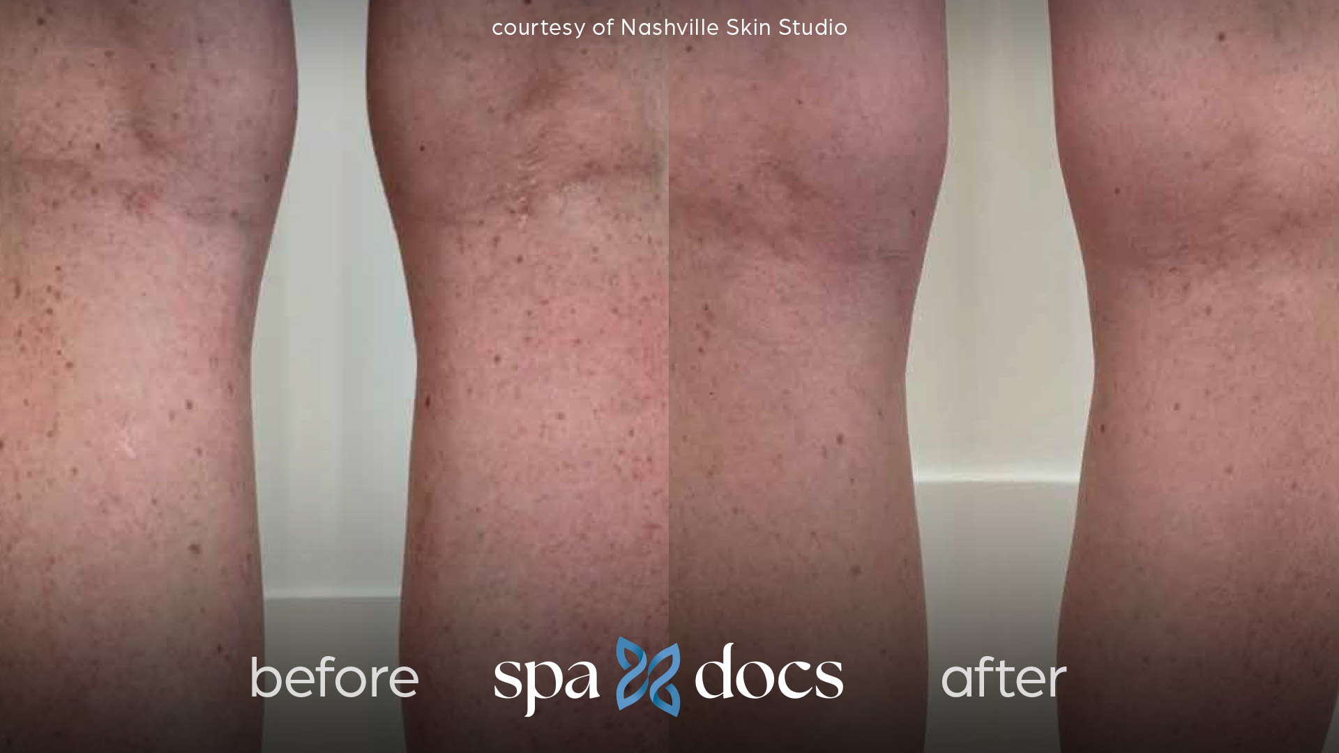 before and after hyperpigmentation removal