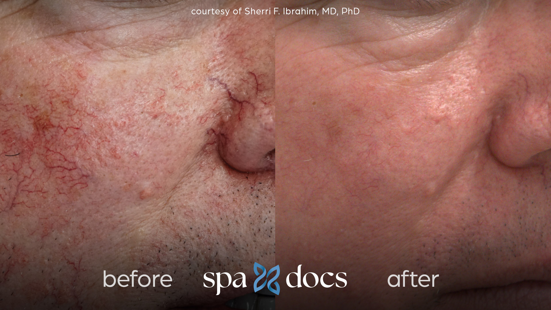 laser treatment for vascular lesions before and after