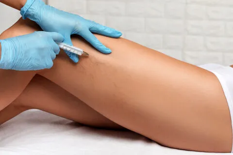 sclerotherapy