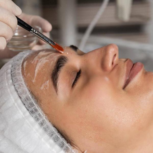 perfect-derma-peel