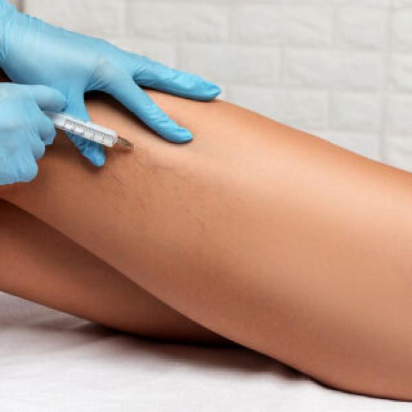 sclerotherapy